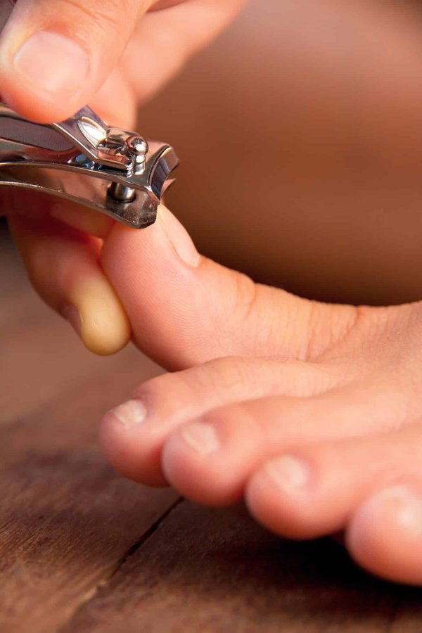 Comment traiter efficacement les ongles incarnés au pied ?